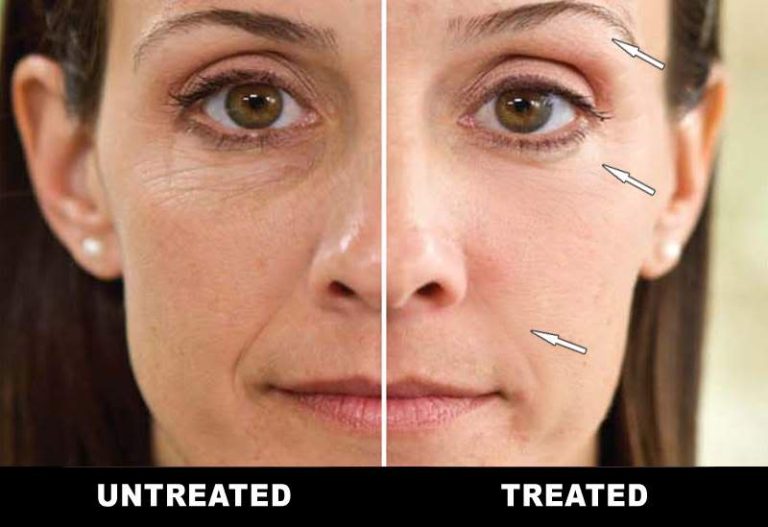 Microcurrent facial treatment