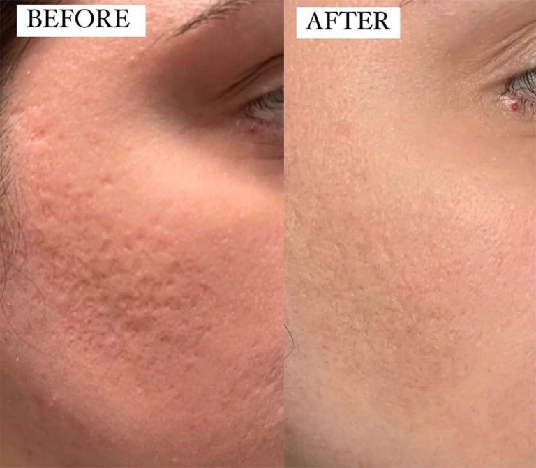 Microneedling skin benefits
