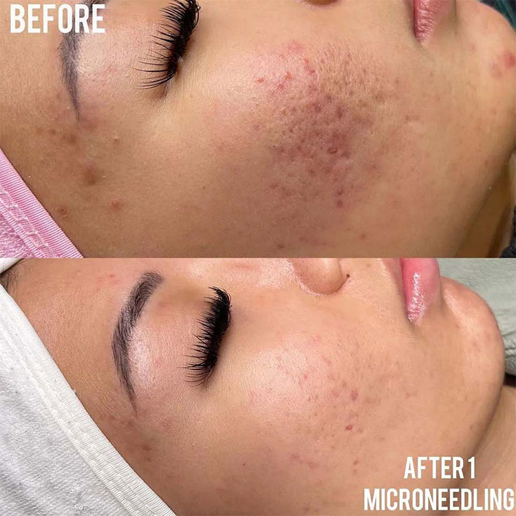 Problems microneedling treats