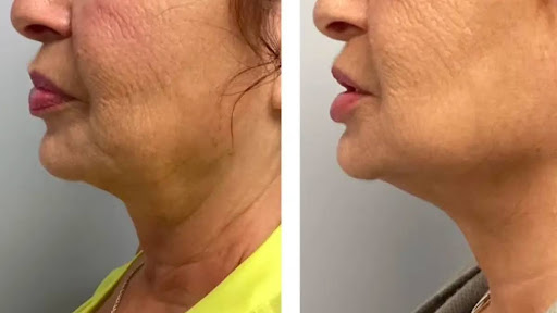 Microneedling side effects