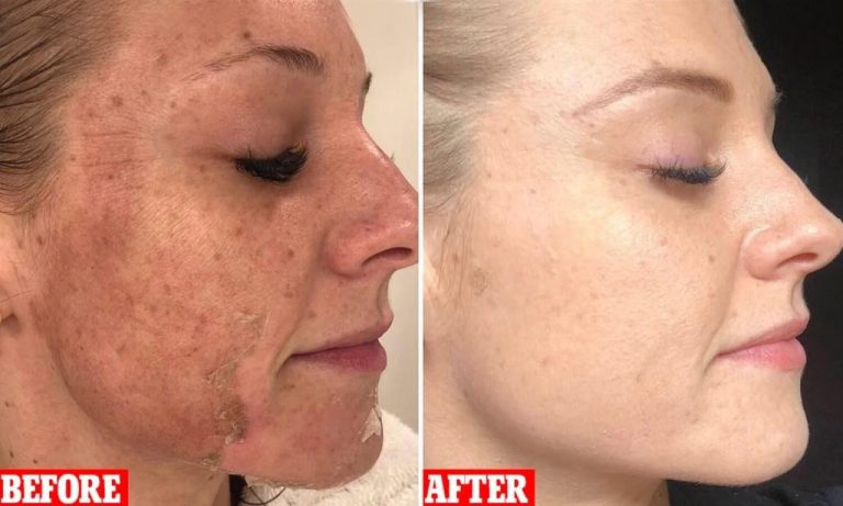 Before and after dermaplaning