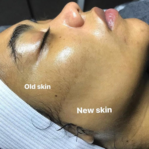 Dermaplaning results