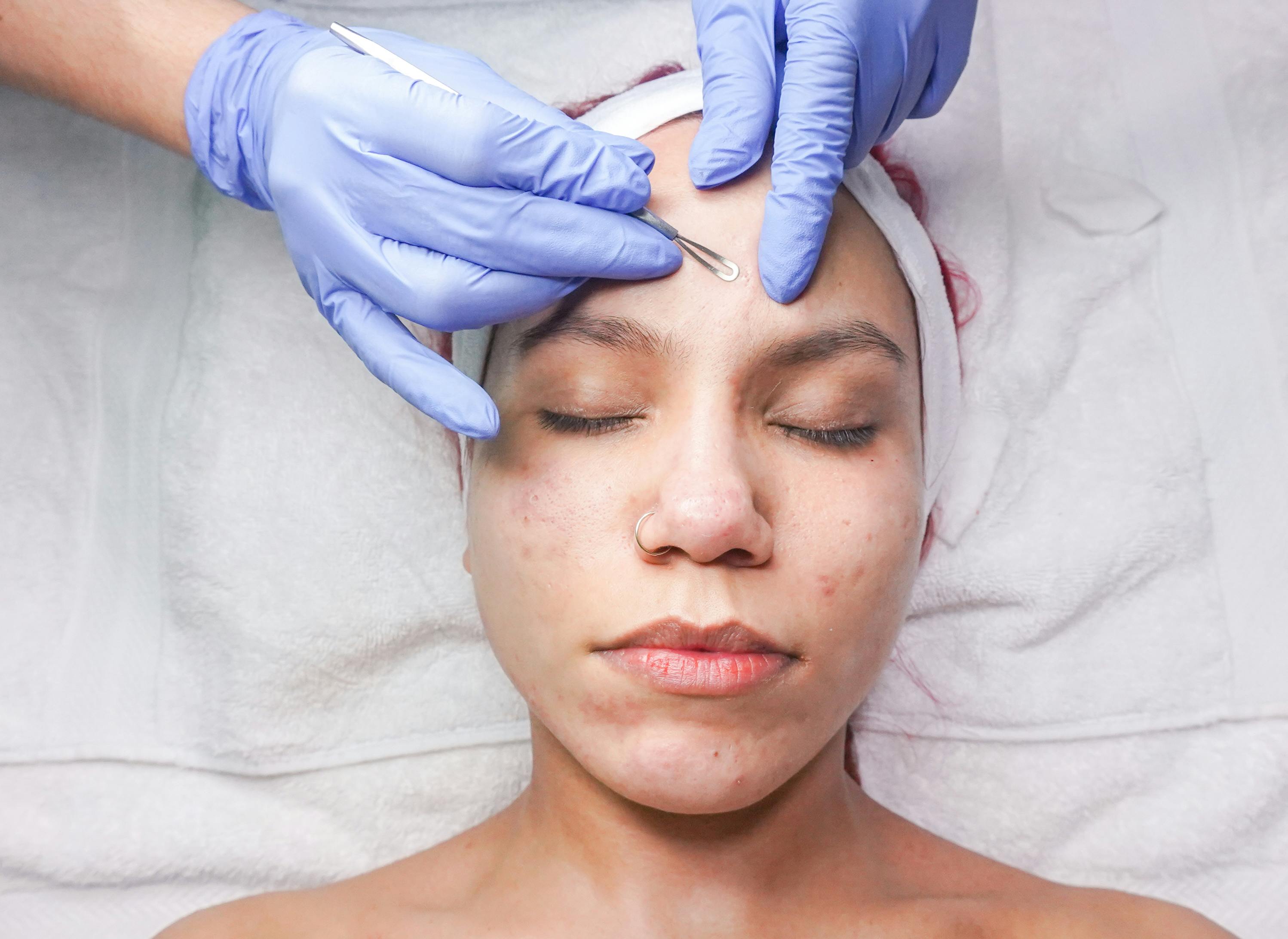 Dermaplaning